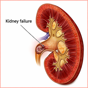Nephropathie